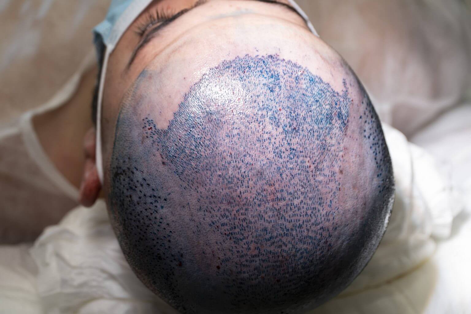 after fue hair transplant surgery