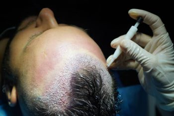 dhi hair transplant surgery results