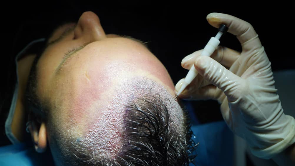 dhi hair transplant surgery results