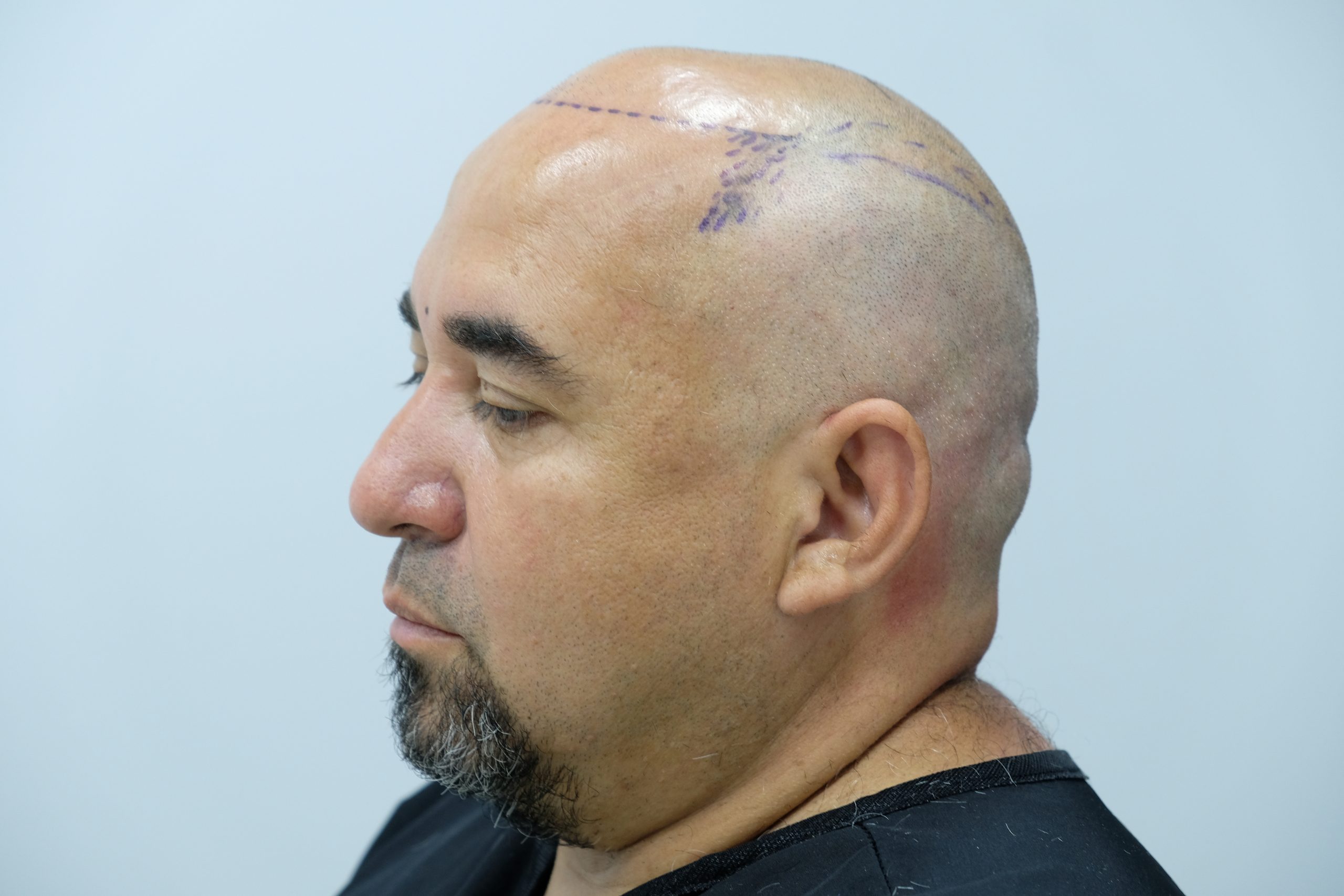 hair loss bald men before hair transplant