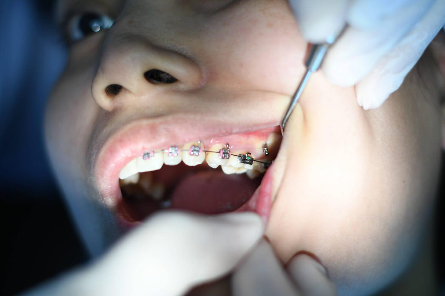 dentist checking a patient's braces